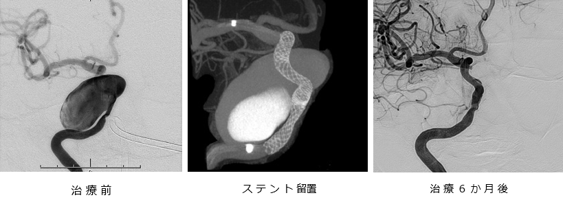 フローダイバーターステント画像 フローダイバーターステント画像
